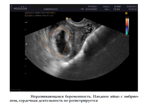 Плодное яйцо прикрепилось в матке. Когда плодное яйцо прикрепляется к. Когда плодное яйцо прикрепляется к. Плодное яйцо в матке узи. Когда плодное яйцо прикрепляется к.