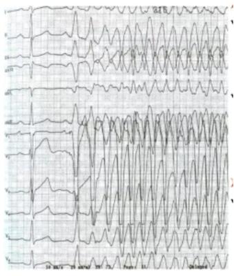 Нарушение сердечного ритма по типу пируэт. Желудочковая тахикардия типа пируэт на экг. Желудочковая тахикардия типа пируэт. Желудочковая аритмия типа пируэт. Тахикардия типа пируэт что это.